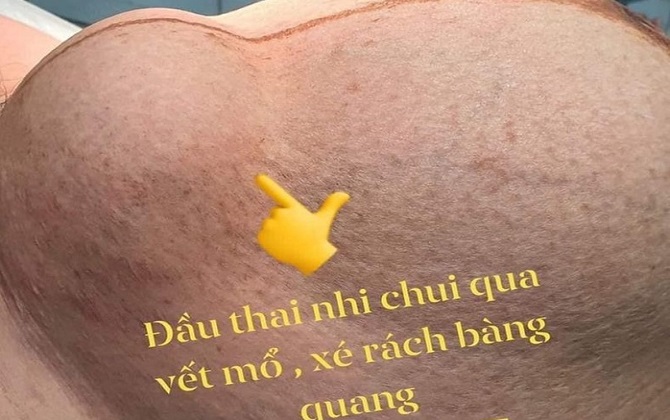 Bác sĩ lên tiếng về sự thật bức ảnh 'sản phụ vỡ tử cung, đầu thai nhi chui qua vết mổ' đáng chú ý