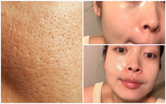 Chăm skincare đêm ngày nhưng lỗ chân lông vẫn to như hố thì chỉ bởi những nguyên nhân này thôi