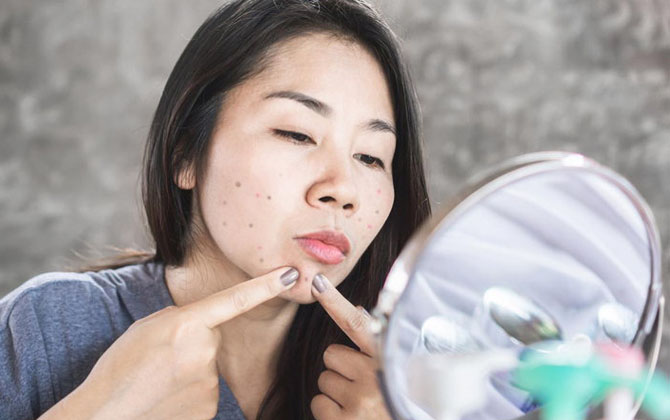7 lỗi sai be bét khiến bạn gái đã quá tuổi dậy thì rồi mà mặt vẫn chi chít mụn