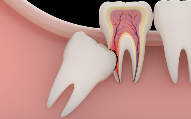 Có thể bạn chưa biết: Không nhổ răng khôn có thể gây nguy hại gì?