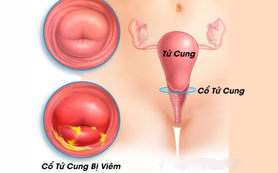 5 triệu chứng cảnh báo viêm cổ tử cung giúp chị em sớm phát hiện và điều trị kịp thời