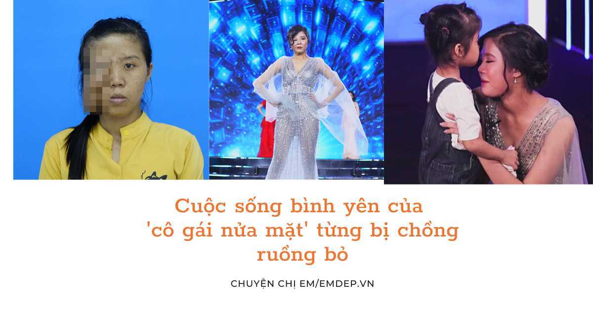 Cuộc sống bình yên của 'cô gái nửa mặt' từng bị chồng ruồng bỏ: 'Tự tin hơn và quý trọng tất cả mọi người quan tâm đến mình'