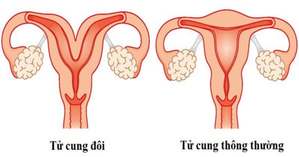 Hiện tượng tử cung đôi và những điều chị em cần biết