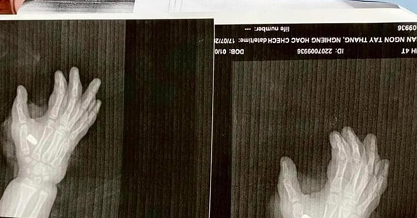 Cháu bé 4 tuổi bị bắn tại quán karaoke ở Thanh Hóa

