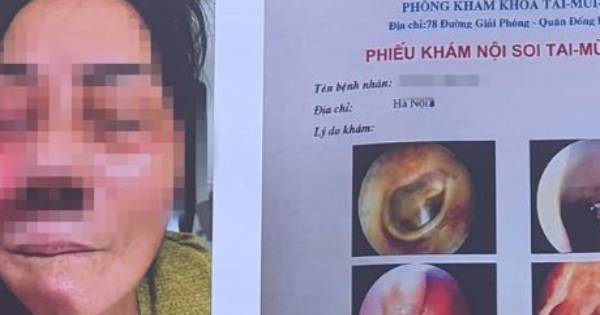 Hà Nội ghi nhận 3 ca hoại tử xương hàm
