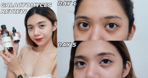 Review top 4 toner trị thâm nổi tiếng nhất hiện nay, 'cứu cánh' cho chị em có làn da thâm mụn