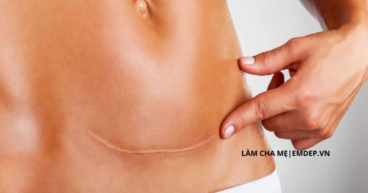 Vì sao cùng là sinh mổ nhưng vết sẹo mổ của tôi lại không đẹp bằng người khác?