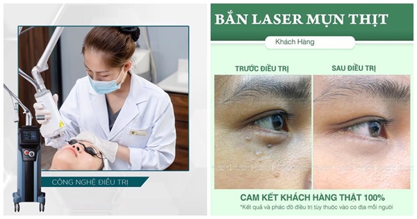 Review địa chỉ đốt mụn thịt tốt và uy tín tại TP.HCM