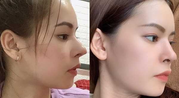 Sụn Surgiform - giải pháp hàng đầu trong sửa mũi hỏng
