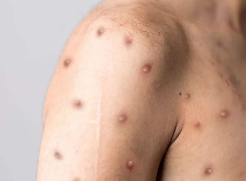 Lây từ con, nam thanh niên 32 tuổi tử vong do mắc thủy đậu
