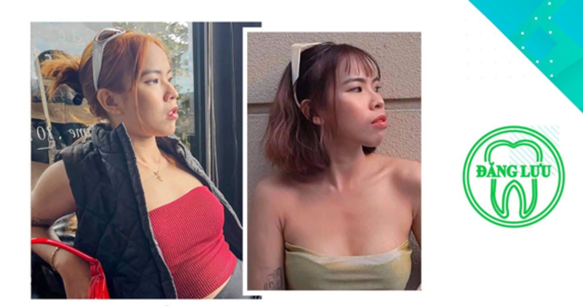 Những lưu ý cần chuẩn bị cho hành trình niềng răng