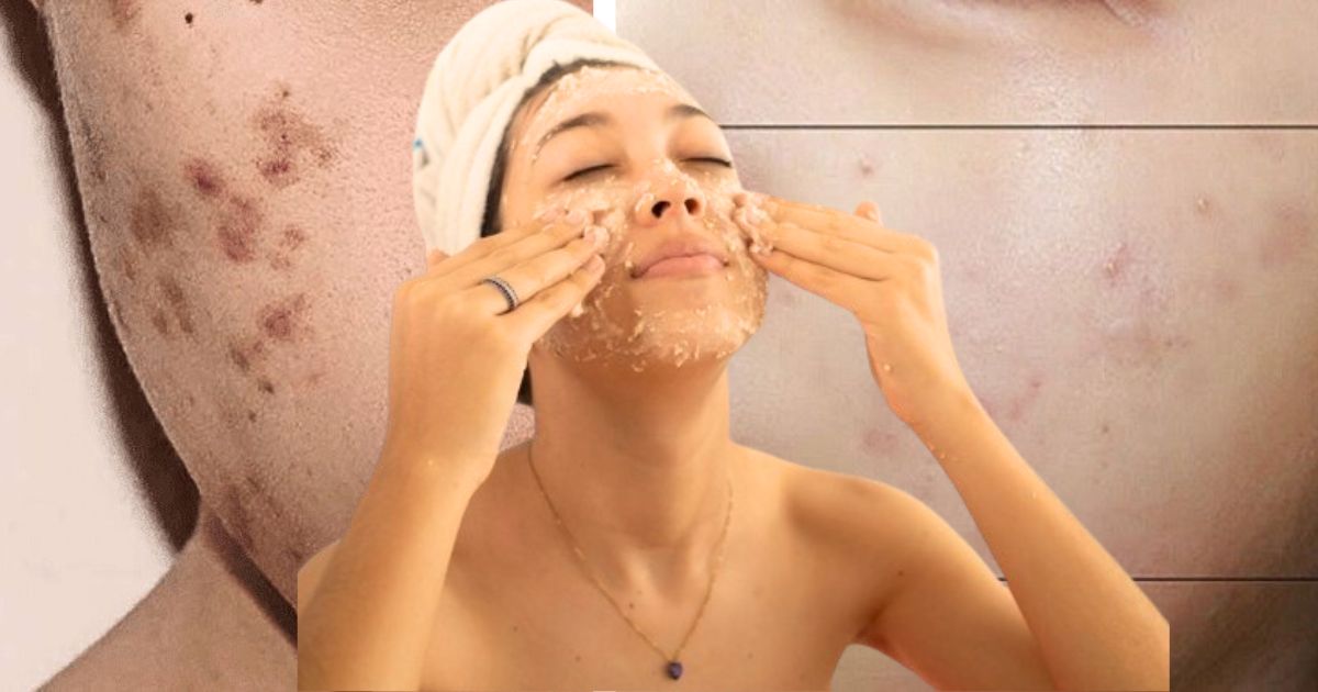 Dẹp sạch mụn trứng cá với 4 cách trị mụn và vết thâm tại nhà