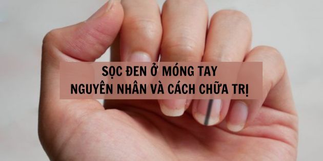 Sọc đen ở móng tay là bệnh gì? Cách chữa trị móng tay có sọc đen