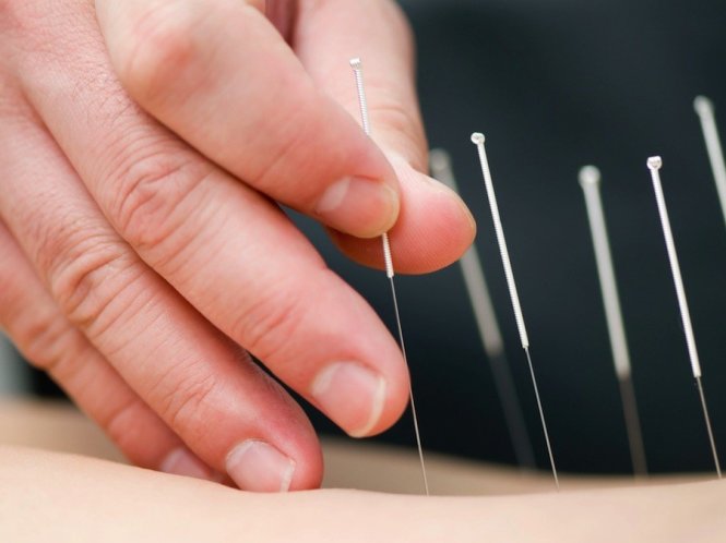 Có nên châm cứu liên tục không? Các biện pháp châm cứu hiện nay