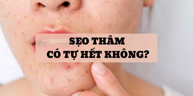 Sẹo thâm có tự hết không? Cách trị sẹo thâm hiệu quả nhất