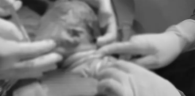 Em bé chào đời với dây rốn quấn 3 vòng cổ

