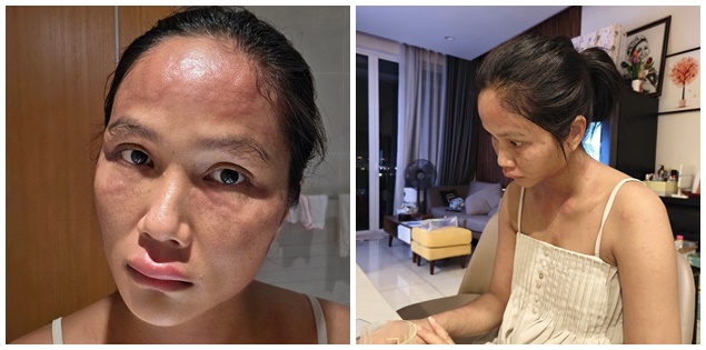 Gương mặt biến dạng sau sinh của H'Hen Niê