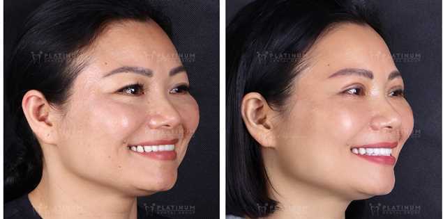 Hành trình giải cứu nụ cười viêm lợi do bọc sứ sai cách: Câu chuyện thực tế từ khách hàng tại Platinum Dental Group    