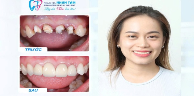 Showcase: Những màn "lột xác" nụ cười từ triết lý Xâm lấn tối thiểu – Độ bền tối đa tại Nha khoa Nhân Tâm