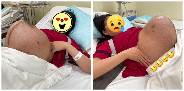 Chiếc bụng bầu thai đôi lớn căng, rạn và sạm màu của người mẹ khiến nhiều người xót xa
